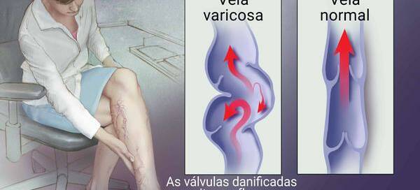 Varizes