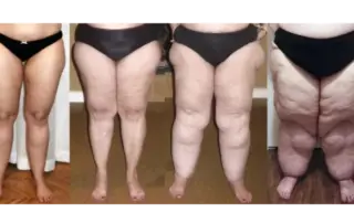 Lipedema