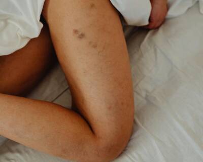 Imagem release menor – Pele pexels-karolina-grabowska-6643069 – março 2025 sinais na pele