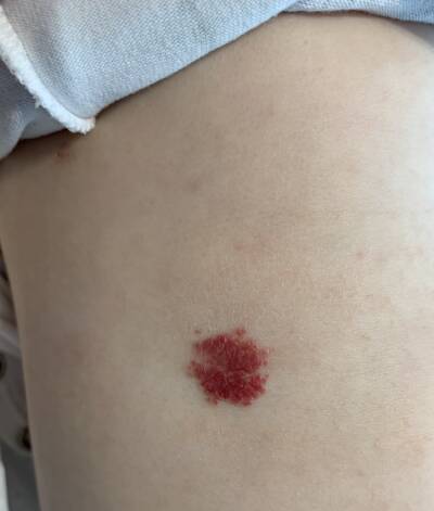 Release Hemangiomas e malformações – foto 2 – Dra. Luisa Release Hemangiomas e malformações - foto 2 - Dra. Luisa